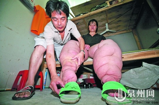 女子身患怪病22年雙腿粗比十年大樹干(組圖)