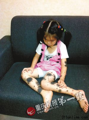 五歲女孩兩三年里滿身長痣需實施數(shù)次手術(shù)(圖)